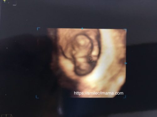 ４Dエコーで見る１０週の赤ちゃん